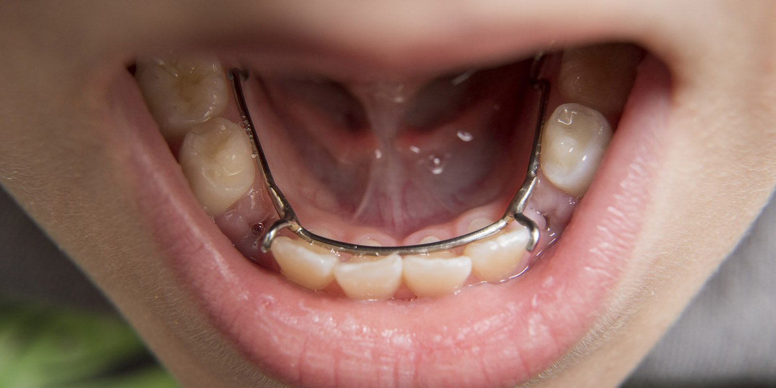 Removable Appliances Convenient Orthodontic Solutions