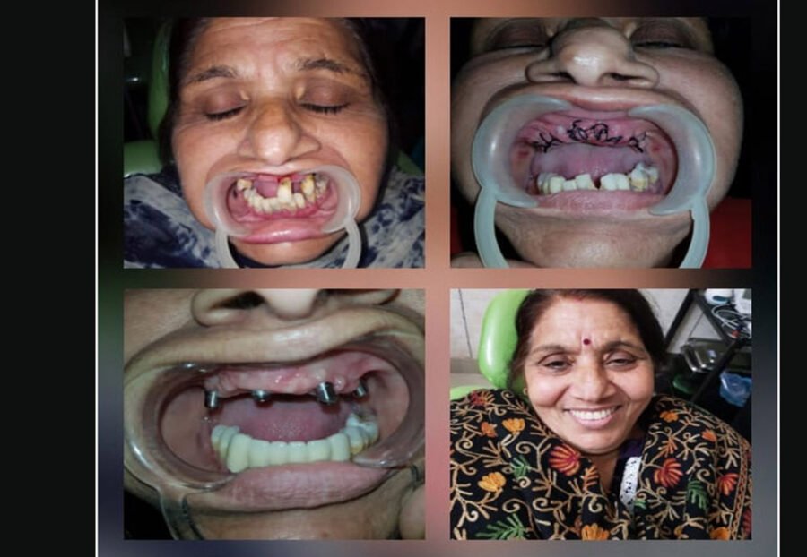 full mouth implants in delhi
