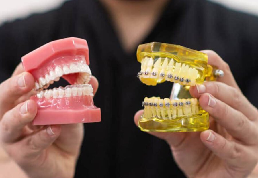 Aligners vs Fixed Braces in delhi