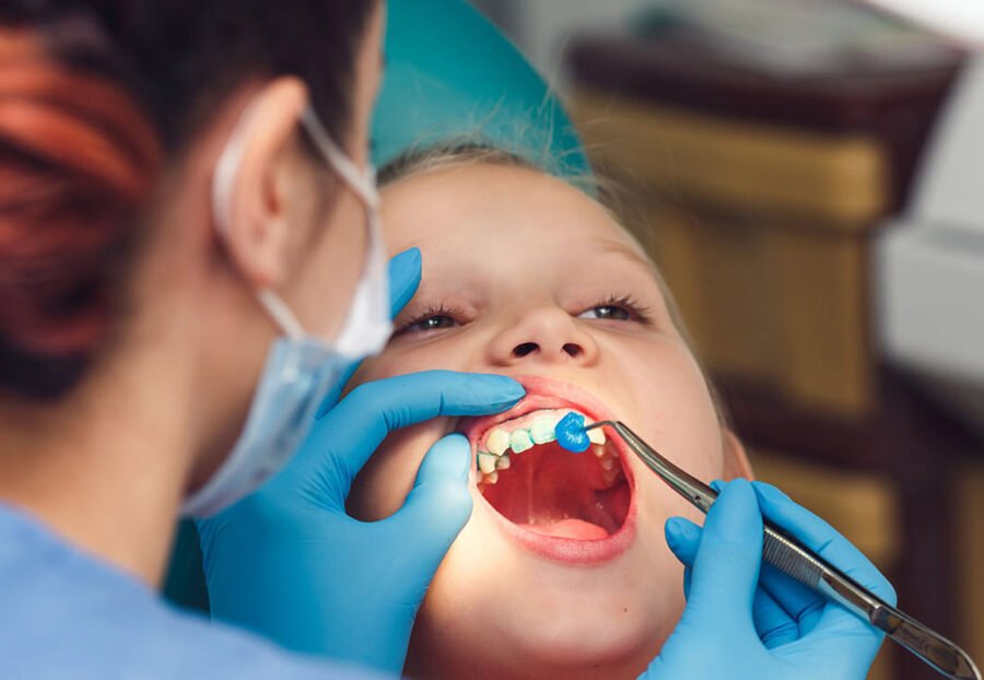 Fluoride Application in Kids