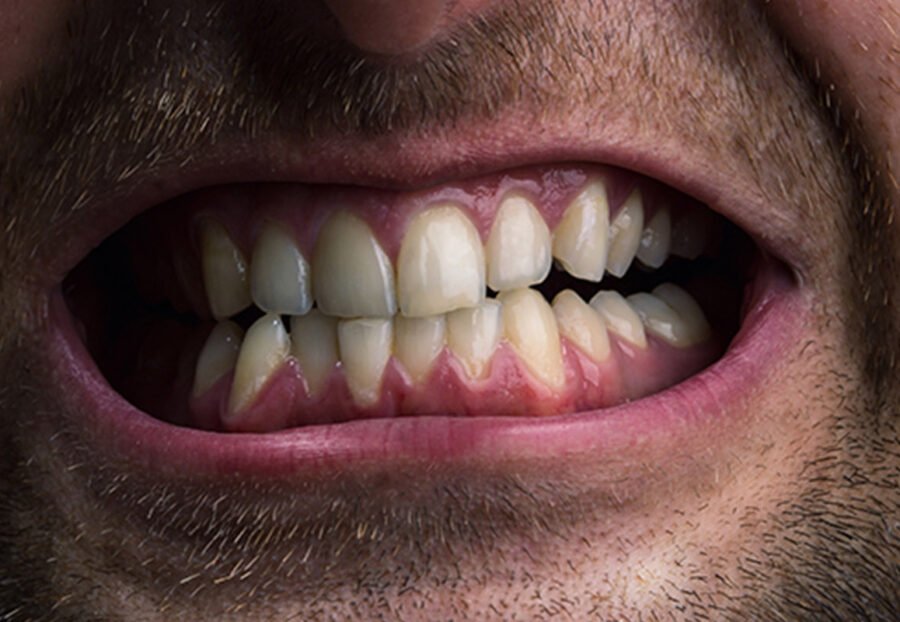 Grinding Teeth to Gum Issues