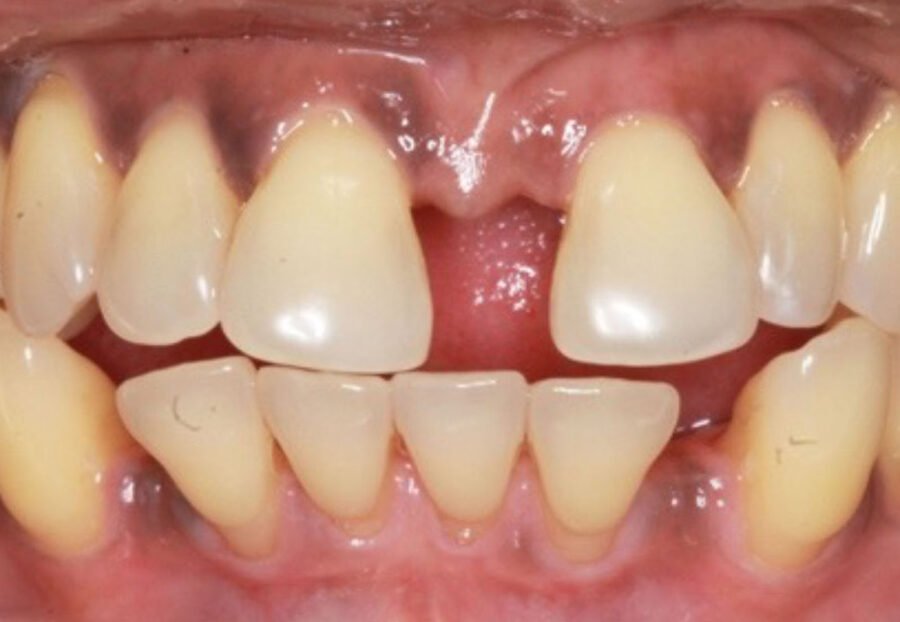 Pathological tooth Migration