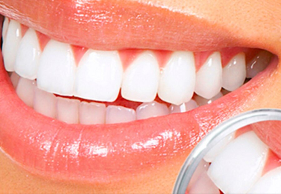 Teeth Bright After Cleaning or Whitening