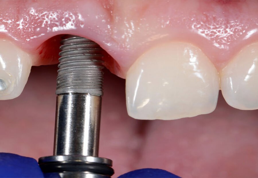 immediate implants in delhi