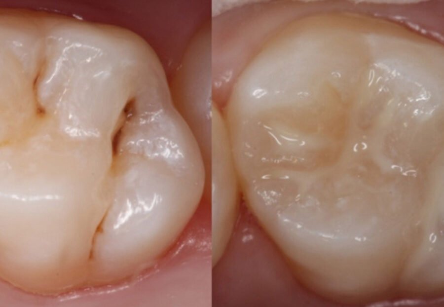 Composite vs GIC Fillings