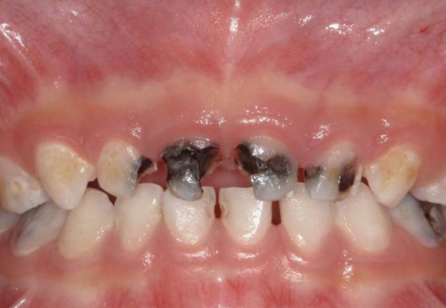 Early Signs of Caries