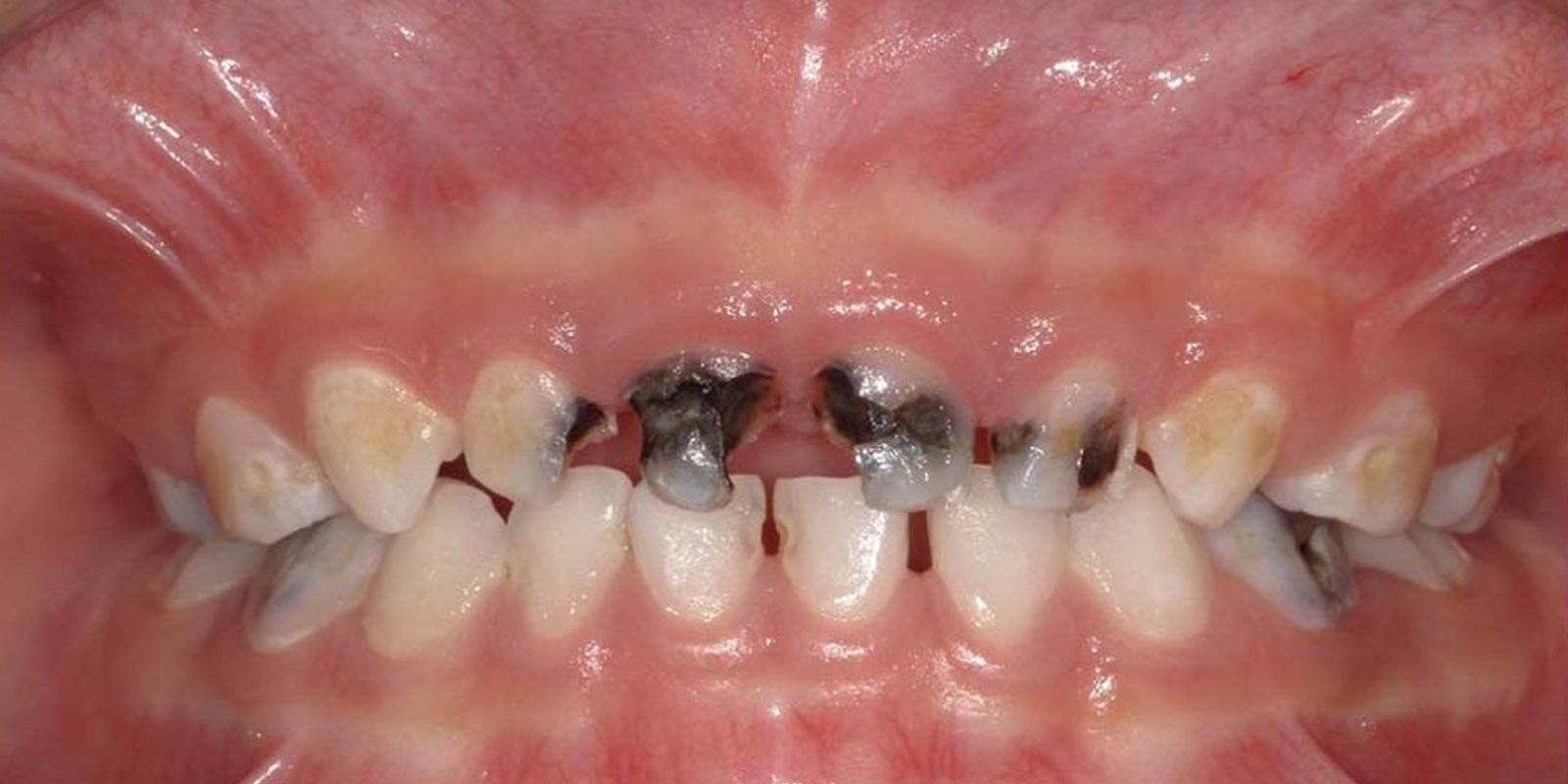 Early Signs Of Caries Detect Tooth Decay Before It Worsens Dr Ankita 