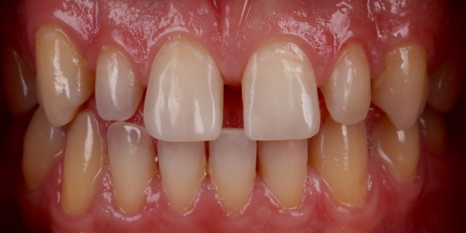 Midline Diastema Correction