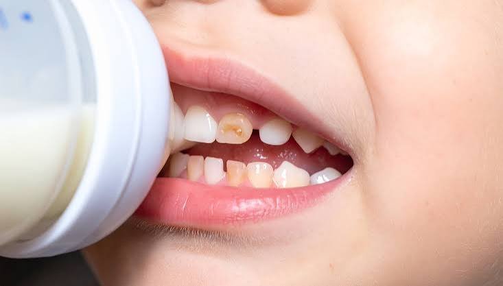 Child drinking from a milk bottle showing baby bottle tooth decay on the front teeth
